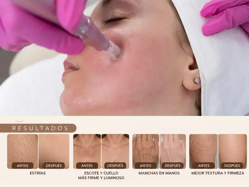 Dermapen Corporal
