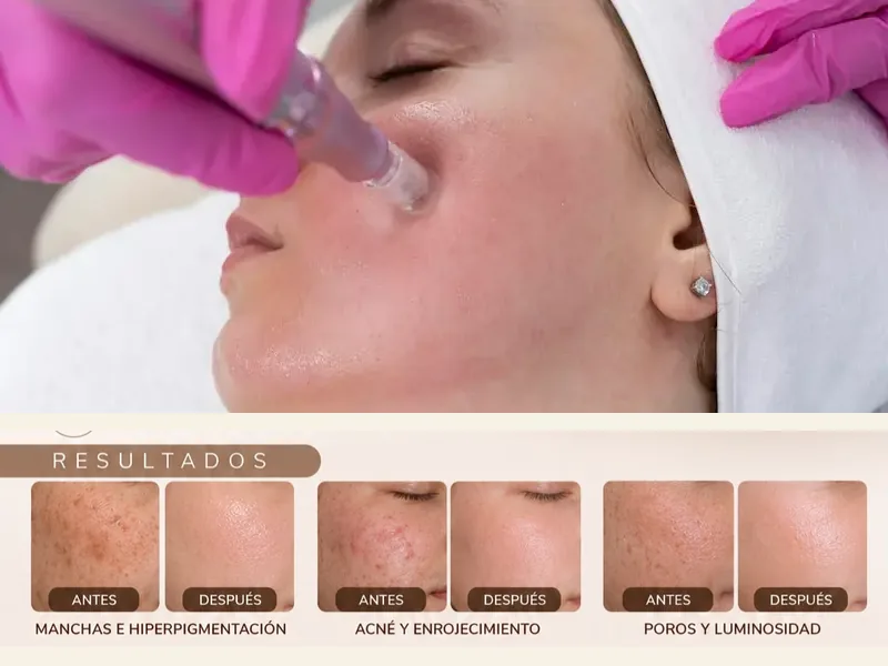 Dermapen Facial con Whitening