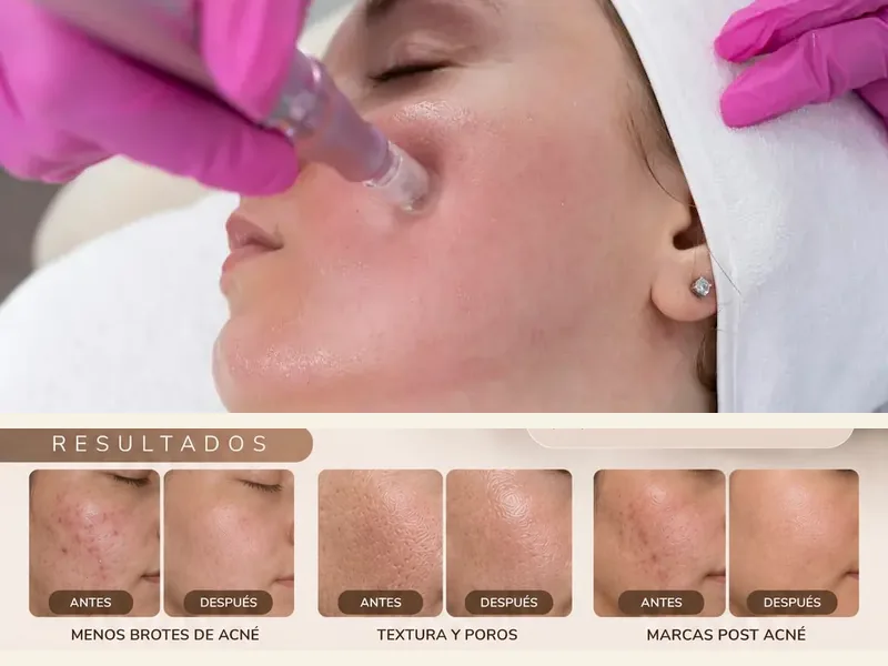 Dermapen Facial Control de Acné