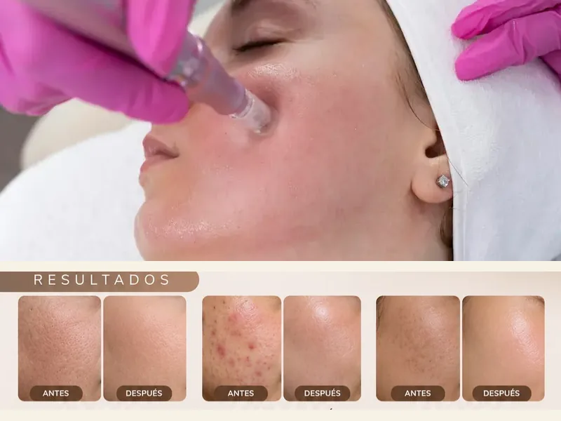 Dermapen Facial con PDRN de Salmón