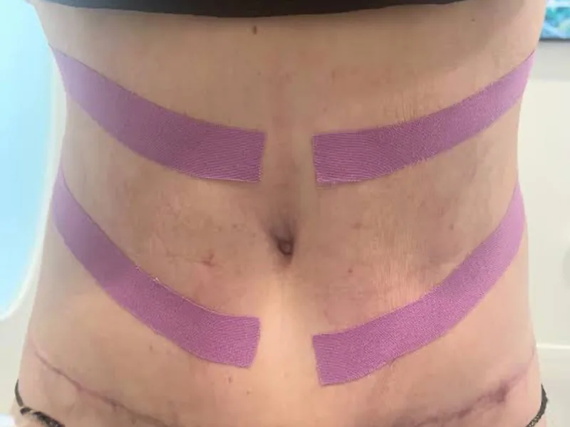 Masaje Post Operatorio y Rehabilitación de Cirugías Plásticas