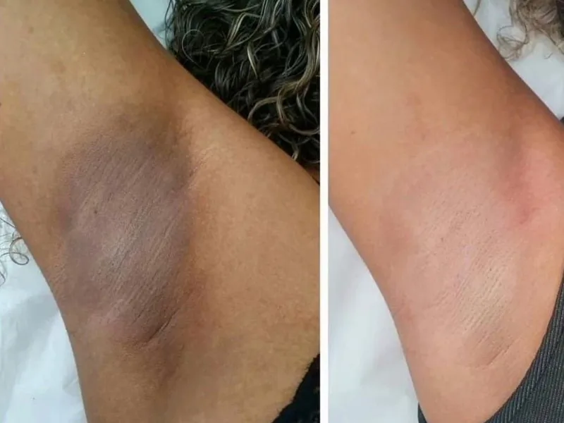 Remoción de Pigmento entre Piernas y Axilas